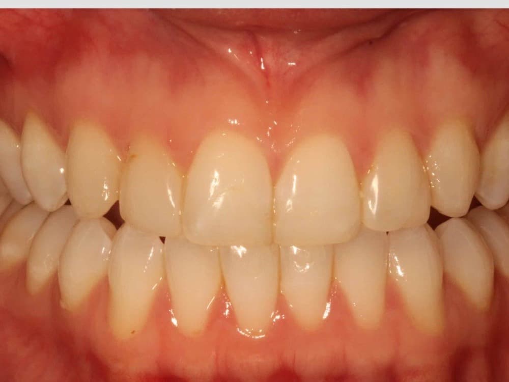 Before treatment — A brighter, more even smile