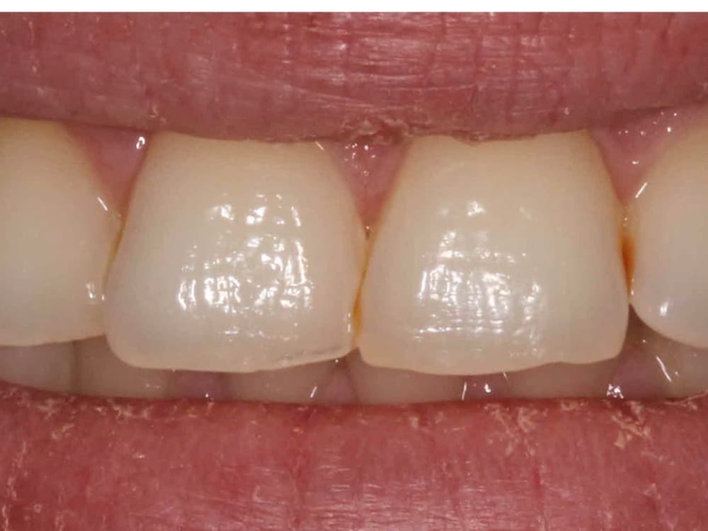 Before treatment — Front teeth rebuilt