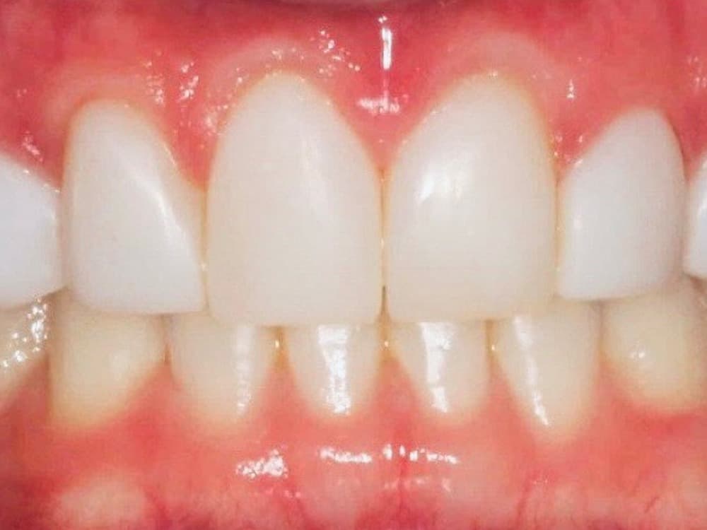 After treatment — Gaps closed and shade lifted