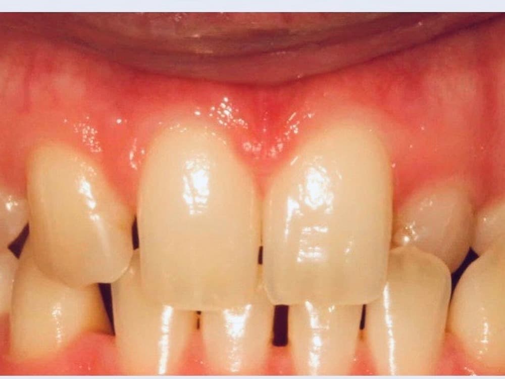 Before treatment — Gaps closed and shade lifted