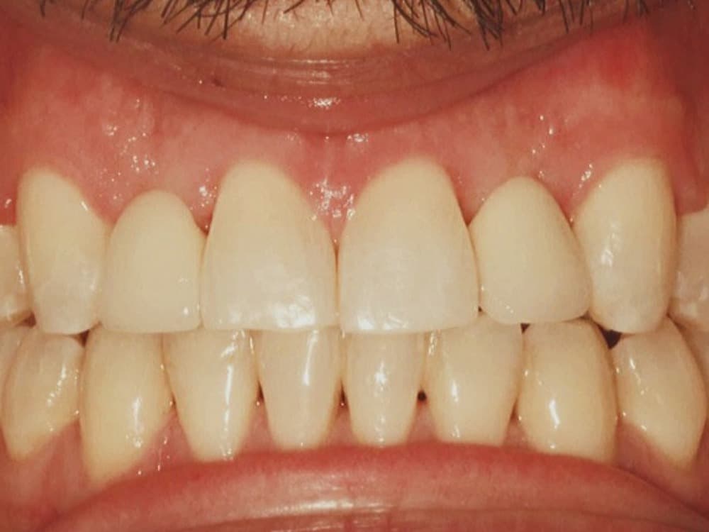 After treatment — Spacing closed, edges evened