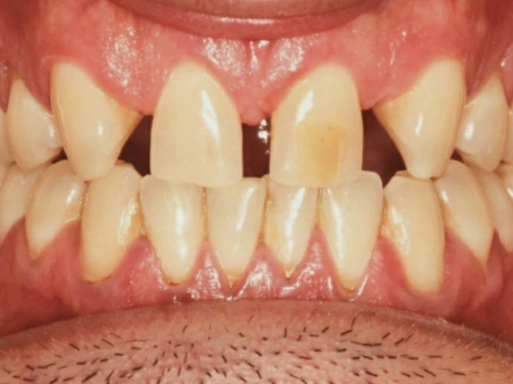 Before treatment — Spacing closed, edges evened