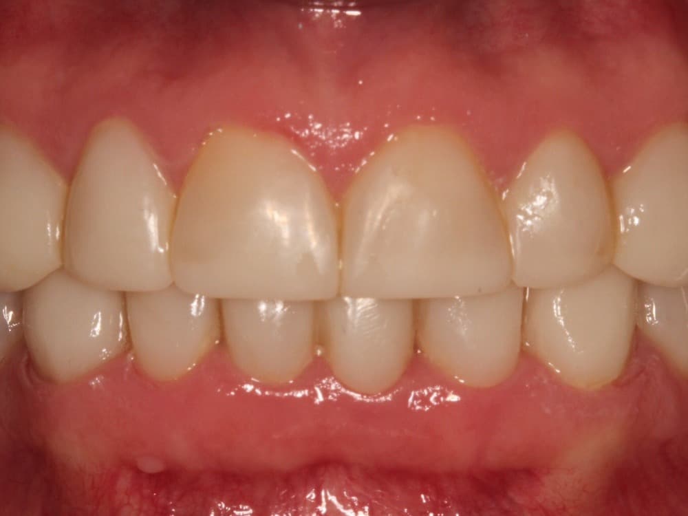 After treatment — Worn, darkened teeth restored