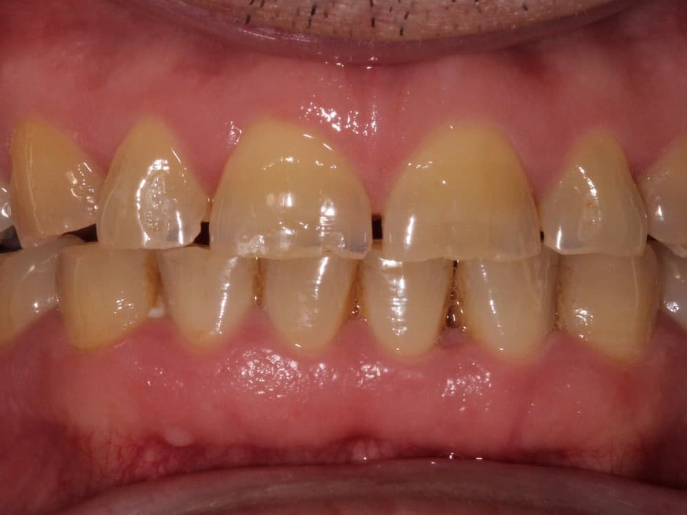 Before treatment — Worn, darkened teeth restored