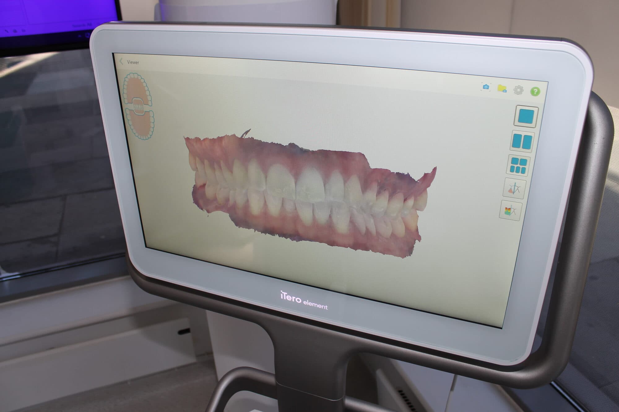 Lingual braces at Hermes London Dental Clinic