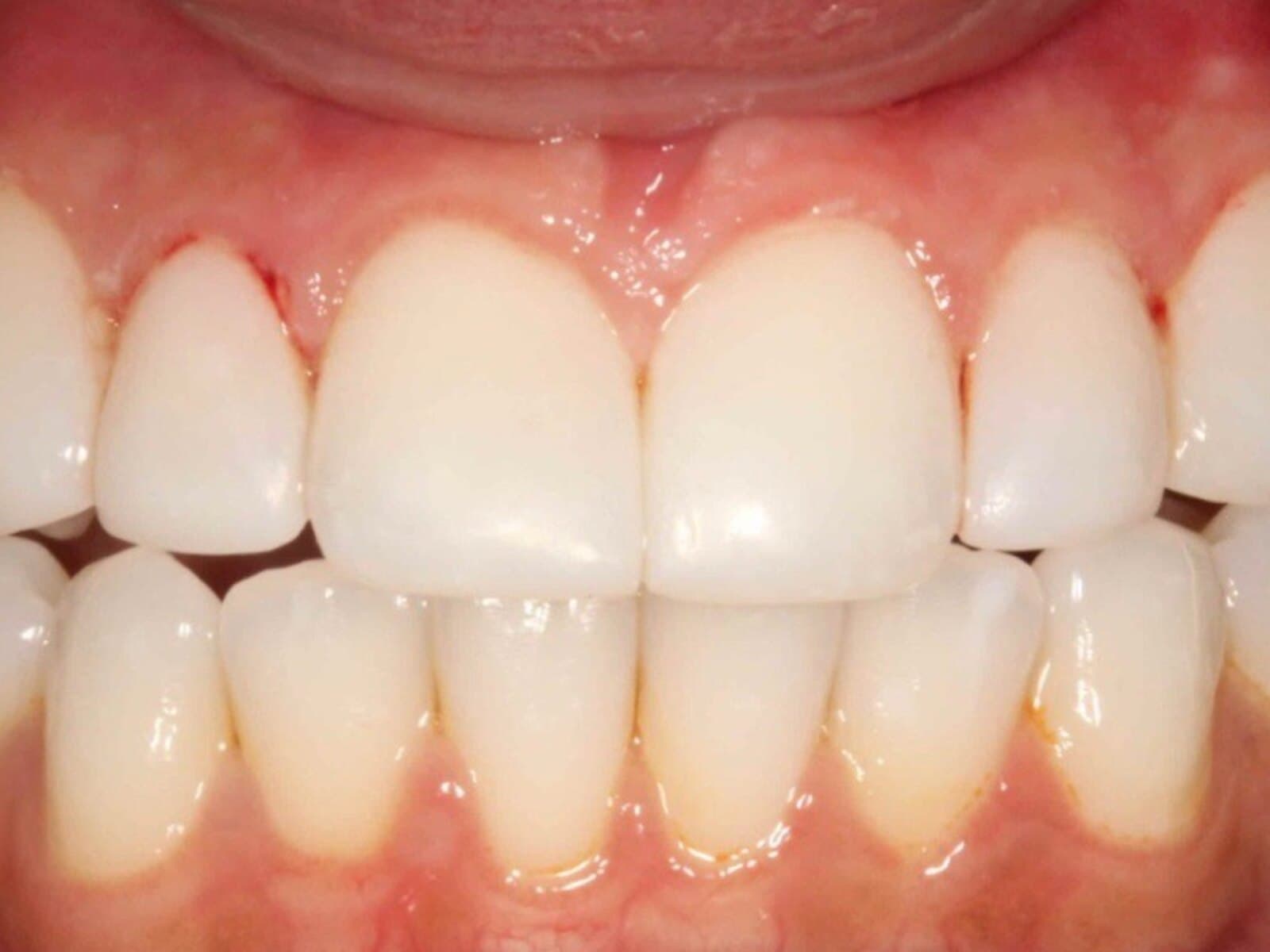 Close-up of a bright, even smile after treatment
