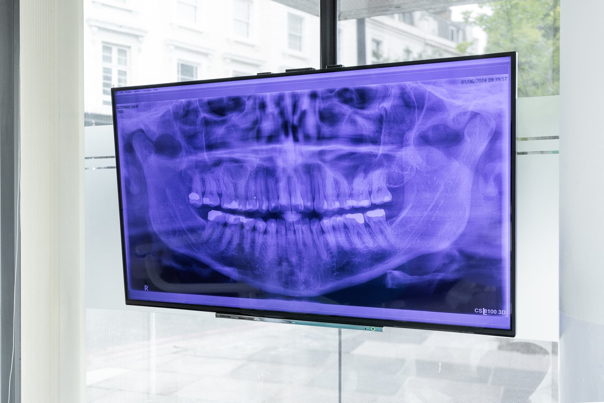 A panoramic dental x-ray displayed on a surgery screen at Hermes London Dental Clinic