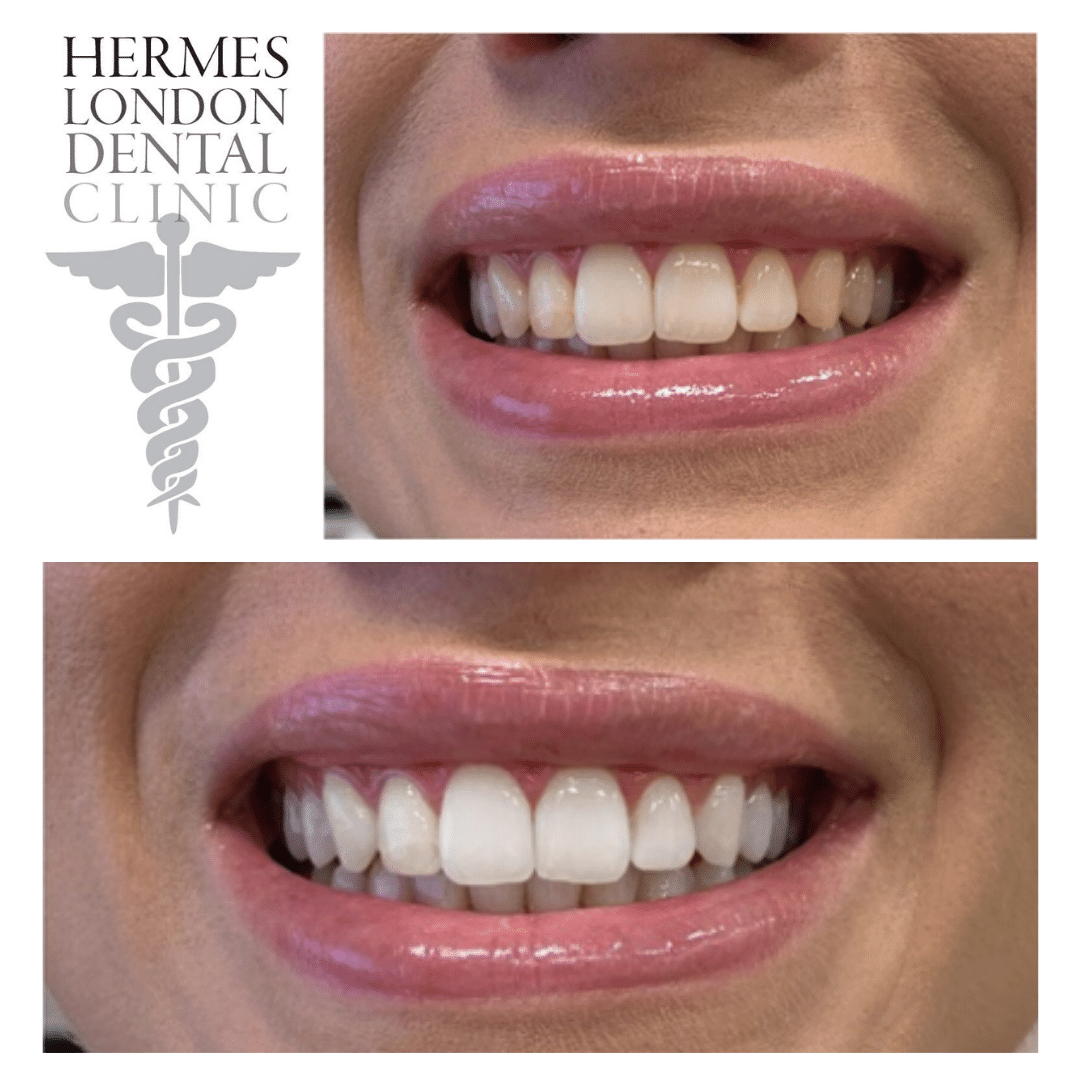 Teeth Whitening London Laser Teeth Whitening London Hermes Dental