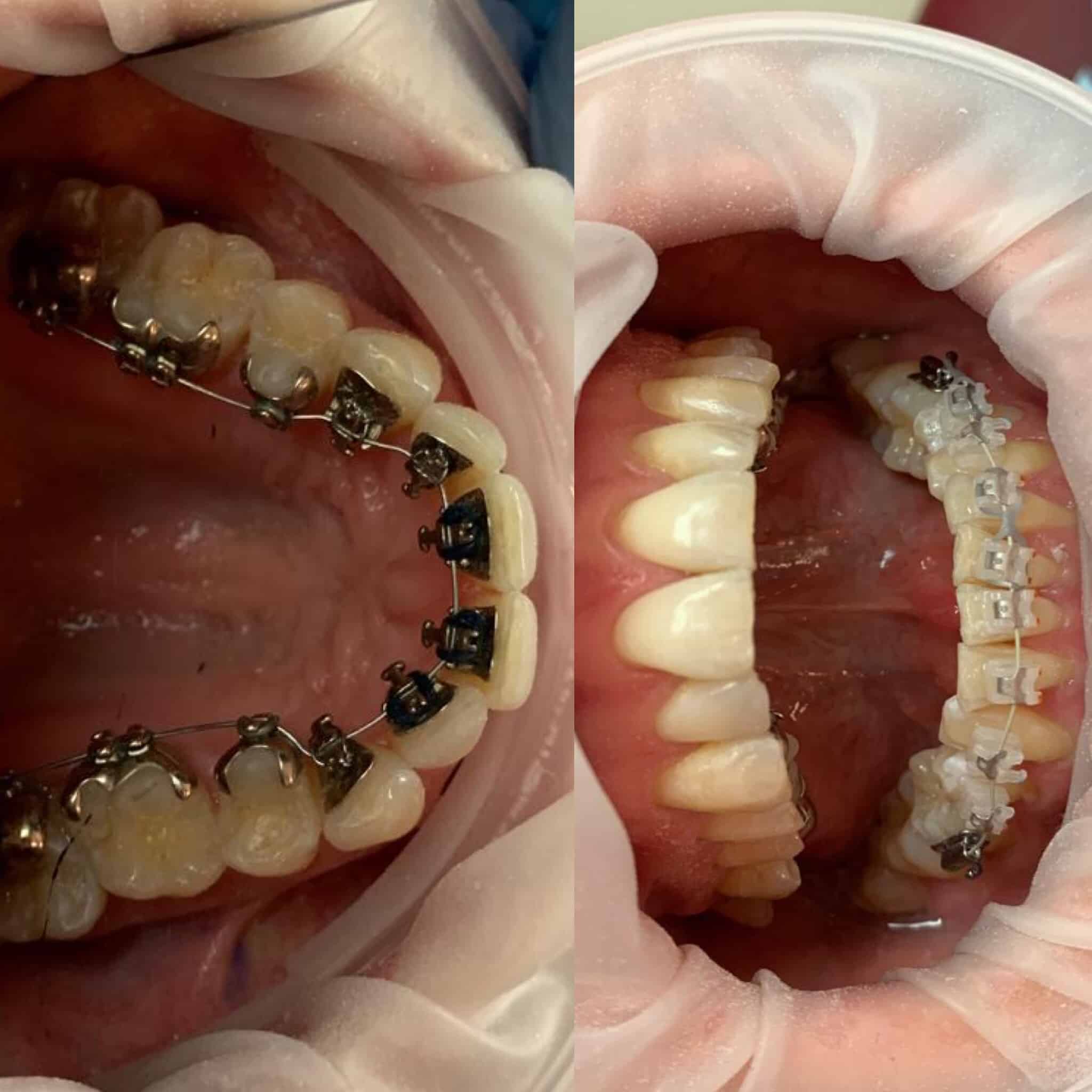 Hermes Private Orthodontist London London Orthodontic Treatments