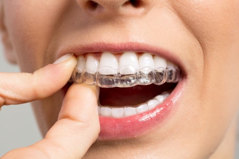 How Much Do Invisalign Braces Cost, London