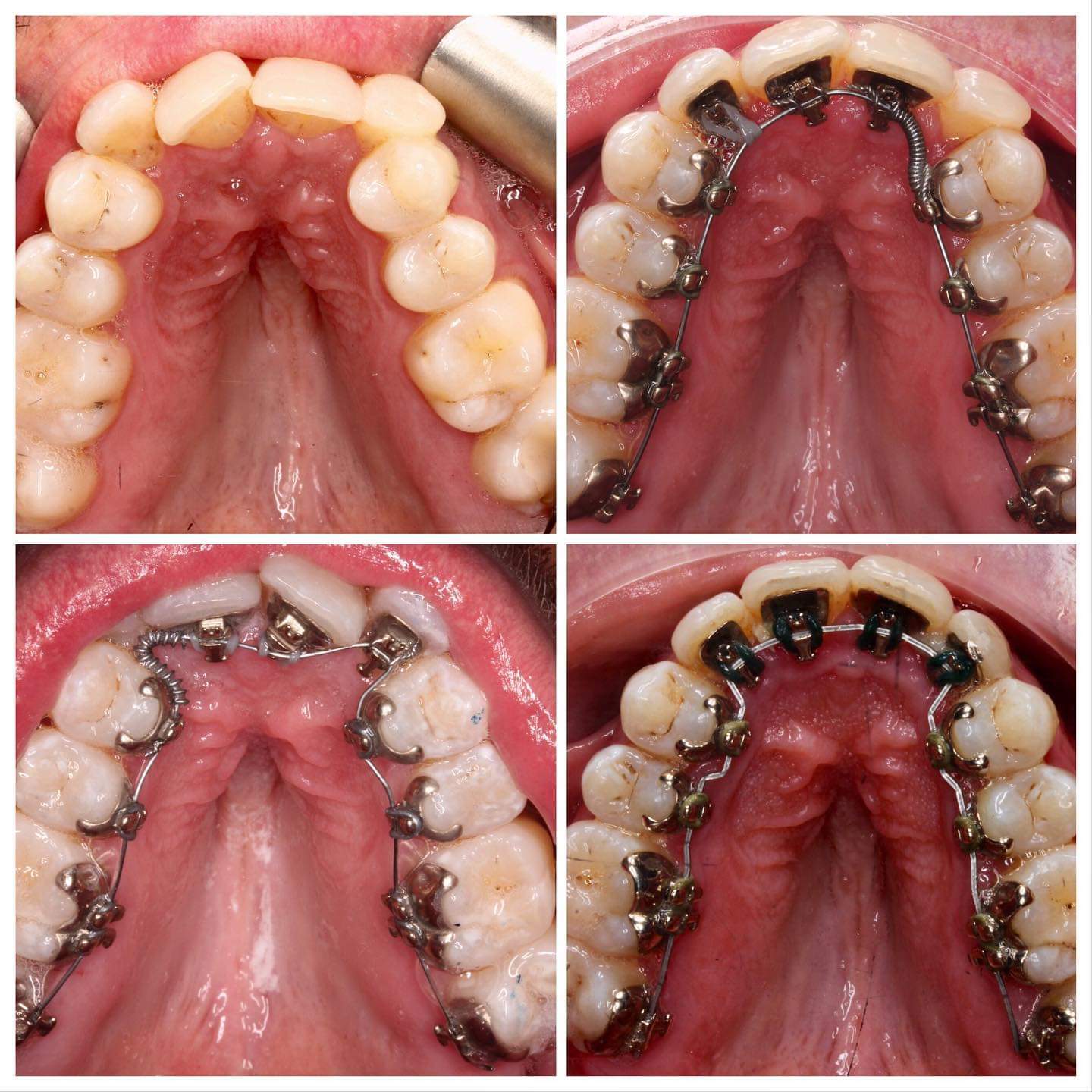 Ceramic Braces Hermes London Dental Clinic