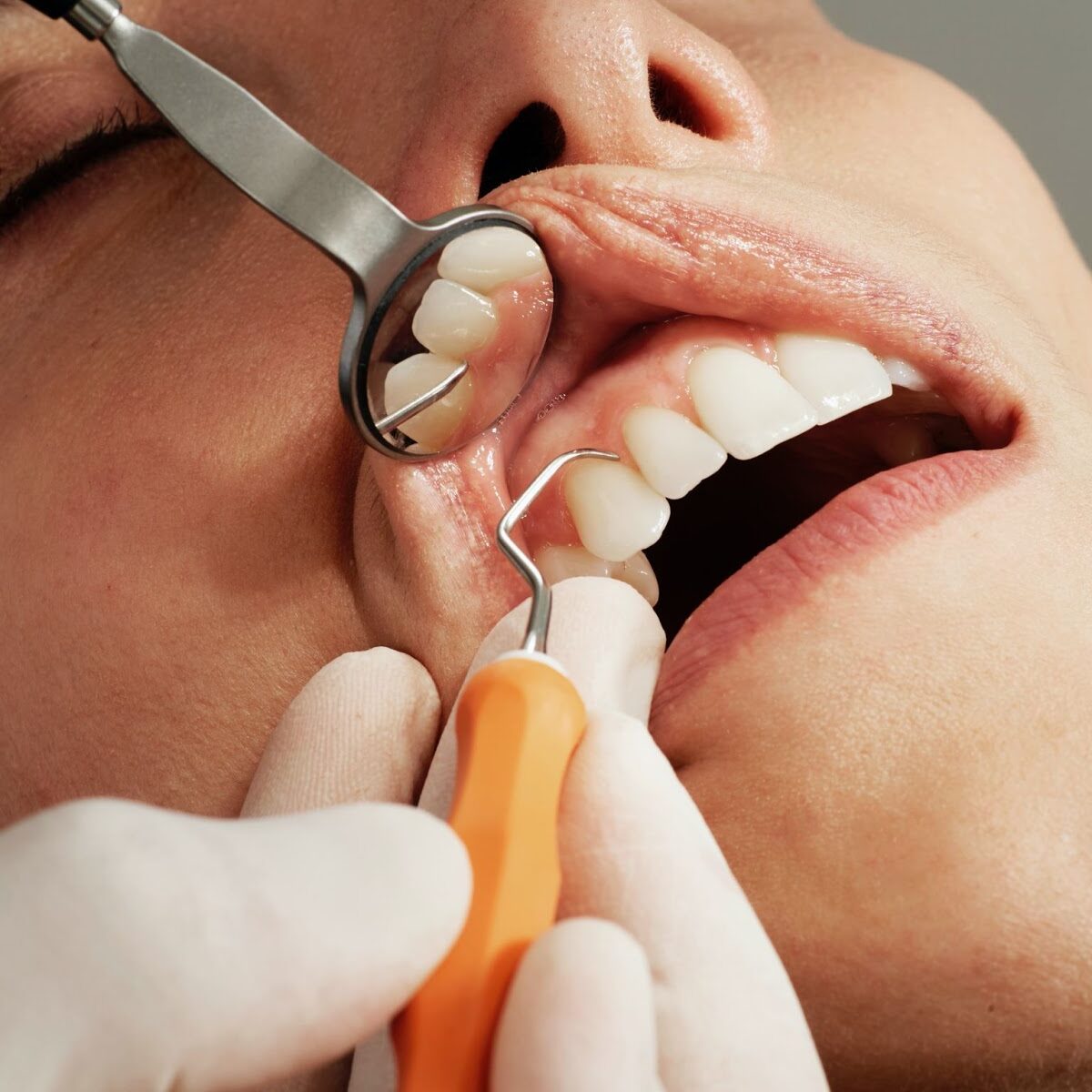 Teeth Cleaning | Hermes London Dental Clinic