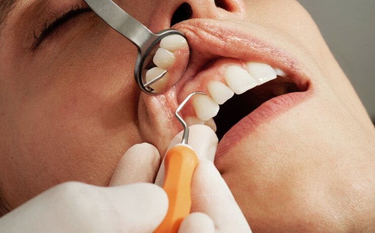 Teeth Cleaning | Hermes London Dental Clinic